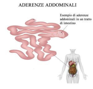 Aderenze_addominali_esempio